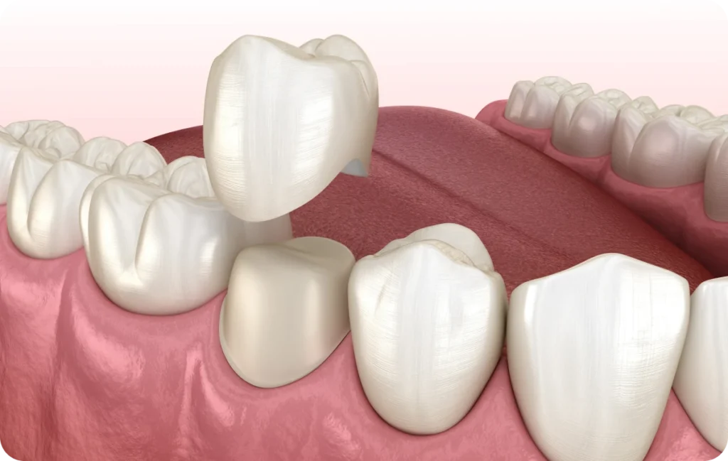 couronne dentiste mesnils sur iton Soins conservatoires