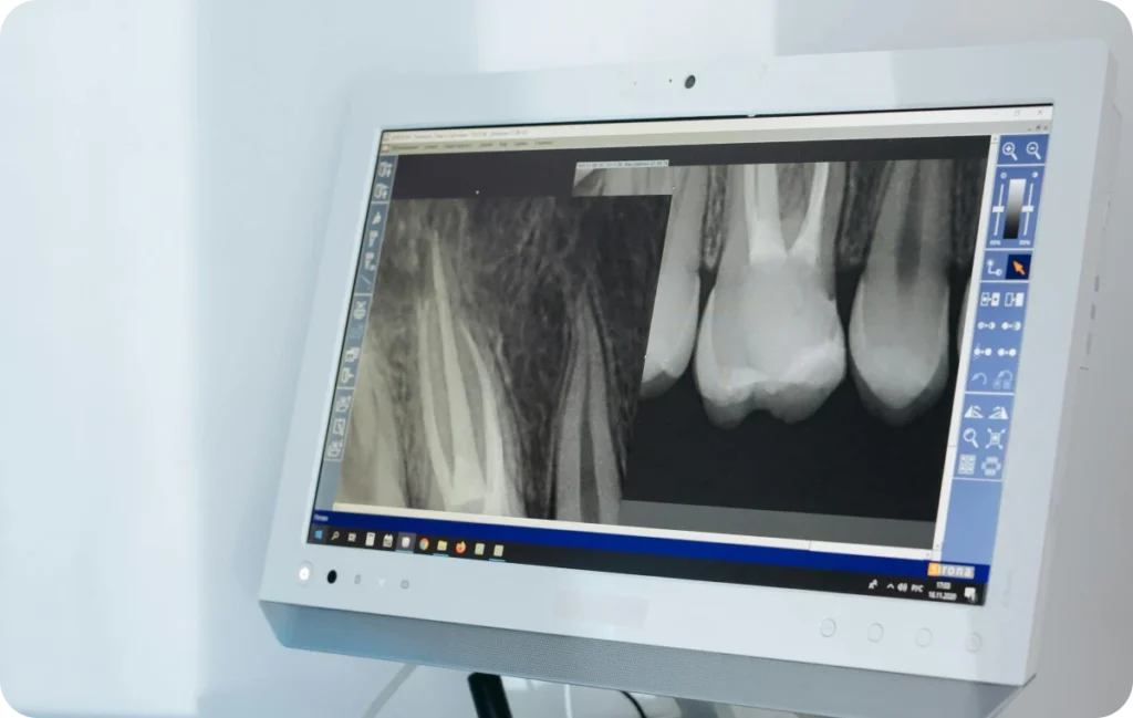 endodontie analyse mesnils sur iton Endodontie
