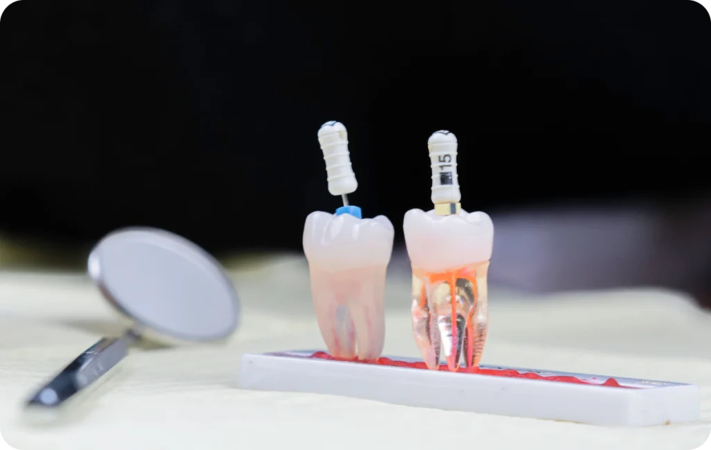 greffe osseuse mesnils sur iton Endodontie