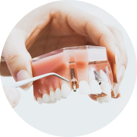 implant cabinet dentaire rosalba mesnil sur iton Soins des prothèses amovibles